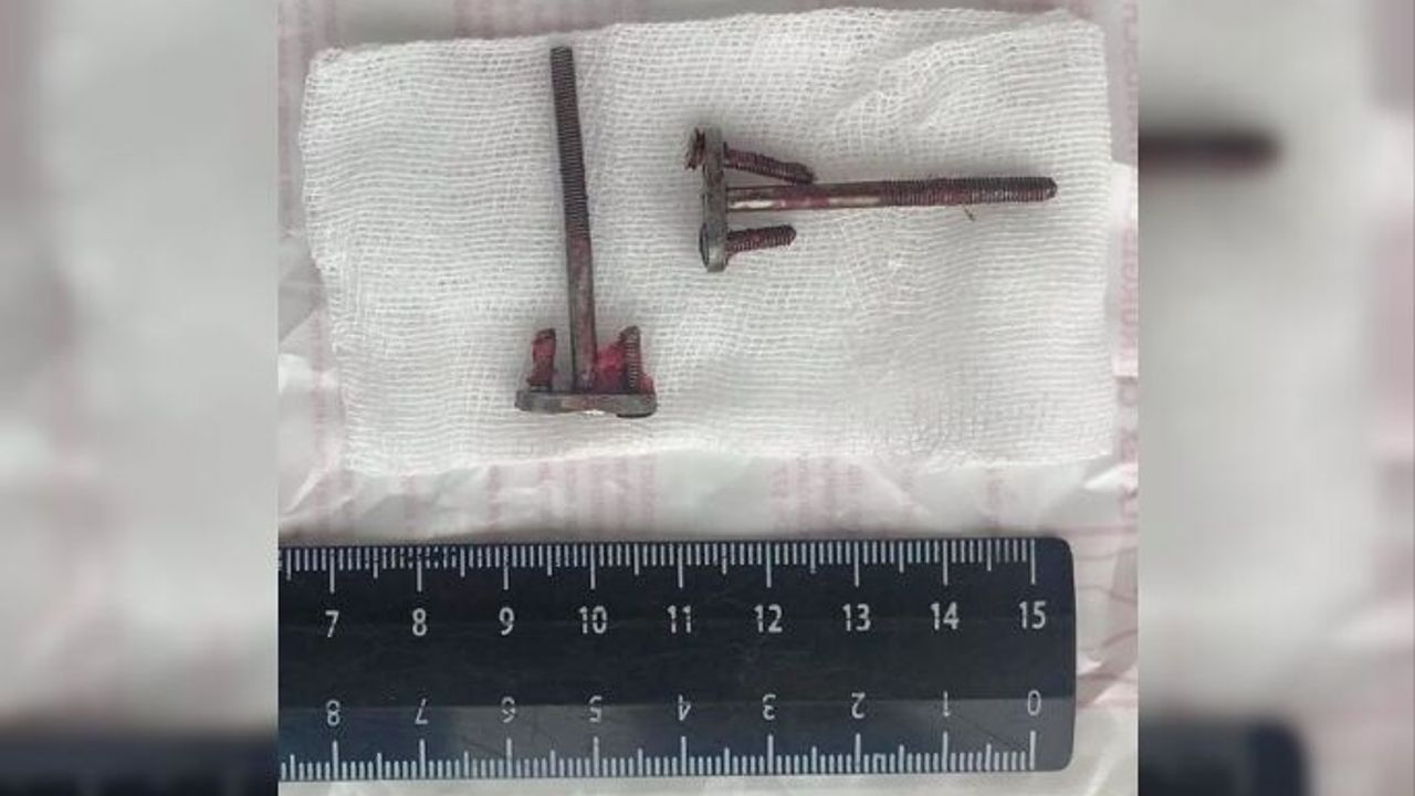 Ağzında implant diye 28 yıl boyunca inşaat vidası taşımış