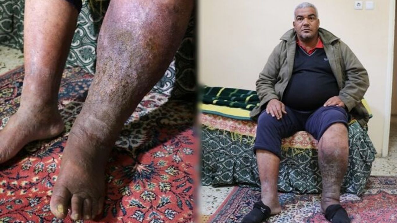 Hastalığın adını duyunca hayatı kabusa döndü