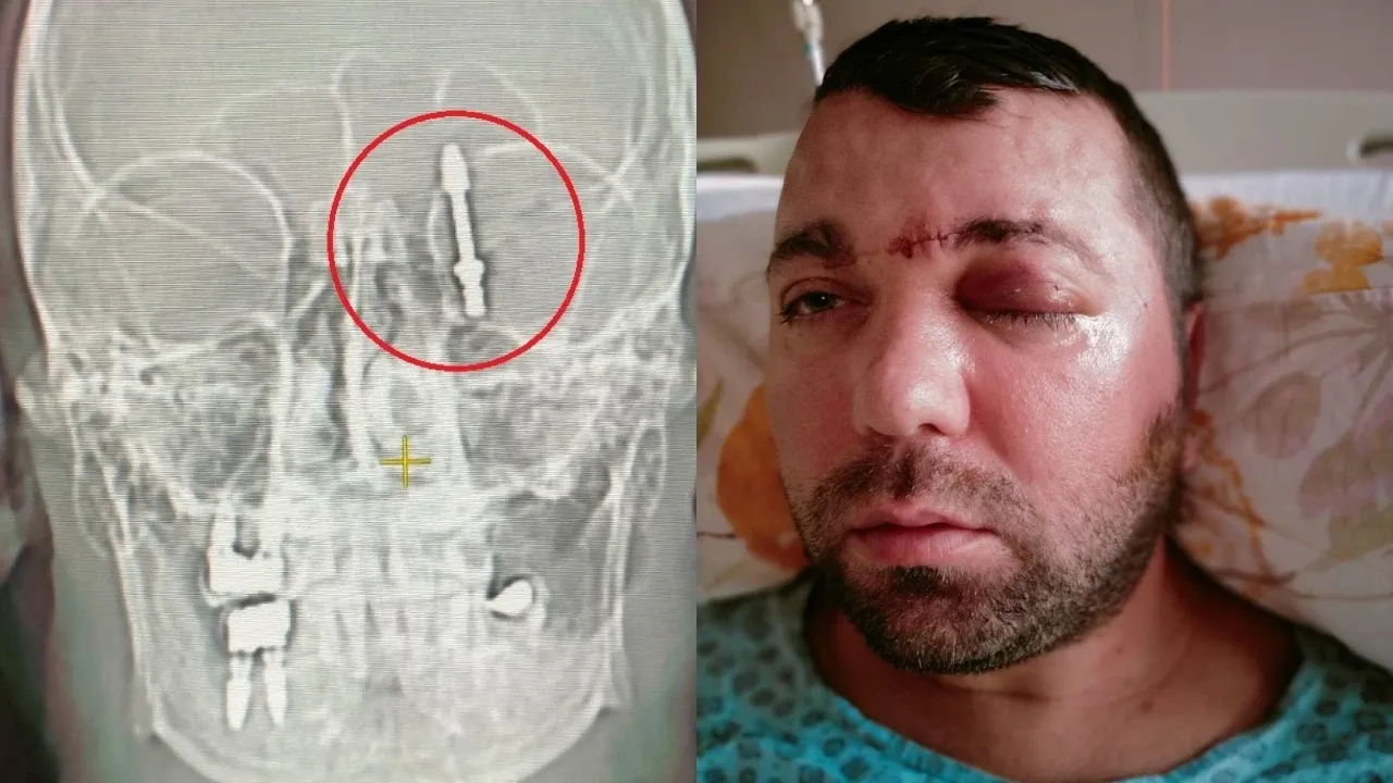 Beynine saplanan implant hayatını kararttı: 2 yıldır adalet bekliyor