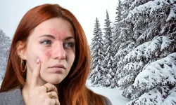 Soğuk havalarda, cildinizde bu belirtilere dikkat