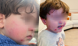 Bursa'da kreşe bıraktığı çocuğunu darp edilmiş şekilde aldı