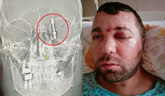 Beynine saplanan implant hayatını kararttı: 2 yıldır adalet bekliyor