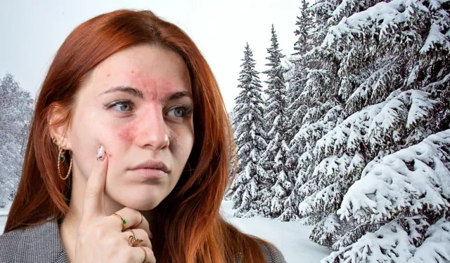 Soğuk havalarda, cildinizde bu belirtilere dikkat